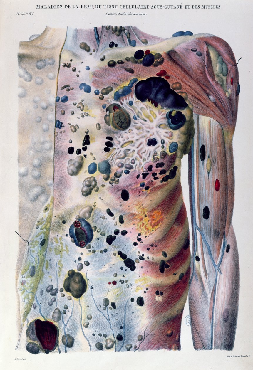 Tumörer och cancerknölar, ur "Anatomie Pathologique du Corps Humain" av Jean Cruveilhier (1791-1874) 1828-42 av Antoine Chazal