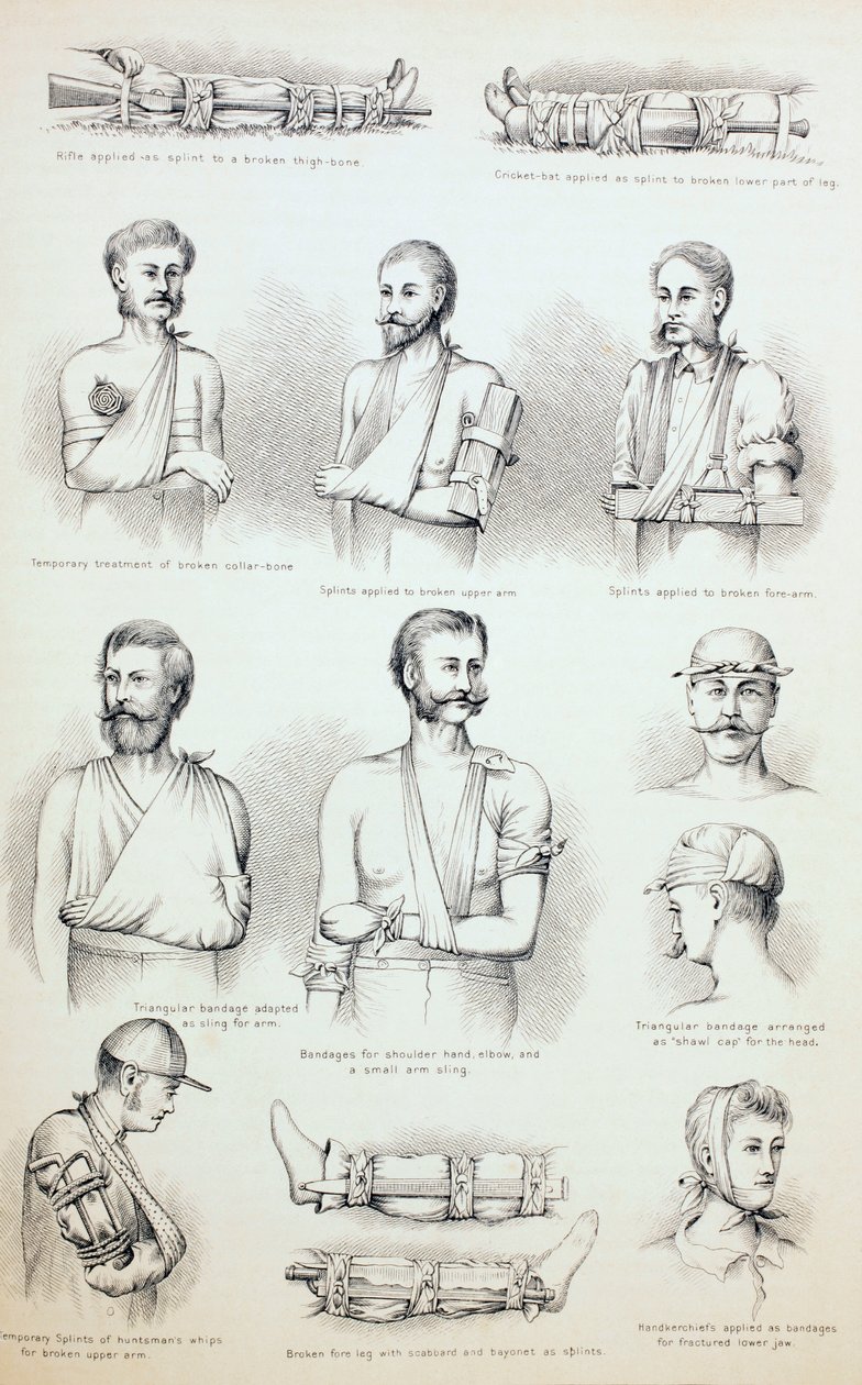 Tillfällig behandling av frakturer, c.1890 av English School