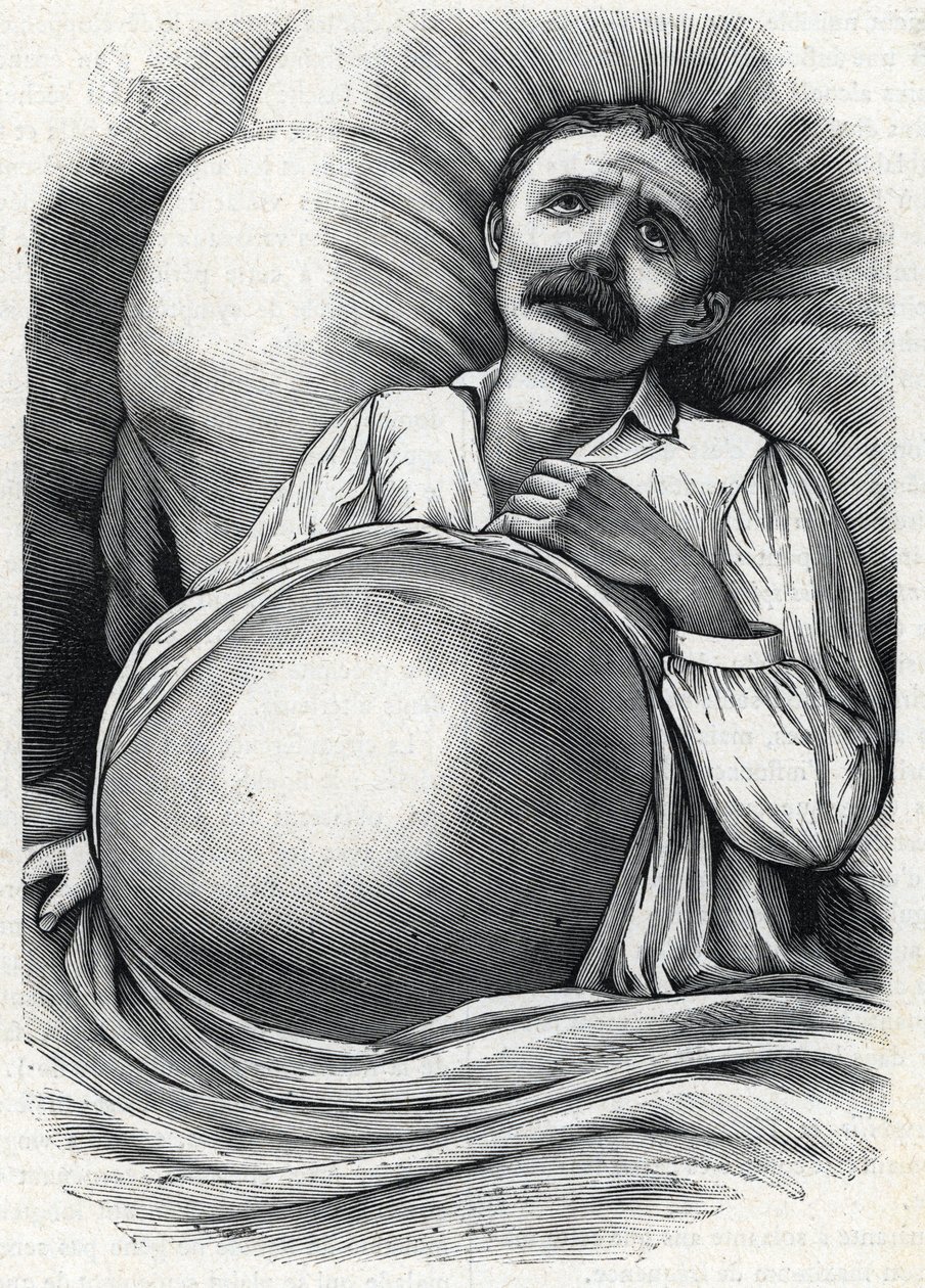 Patient med avancerad levercirros (gravyr) 1888 av French School