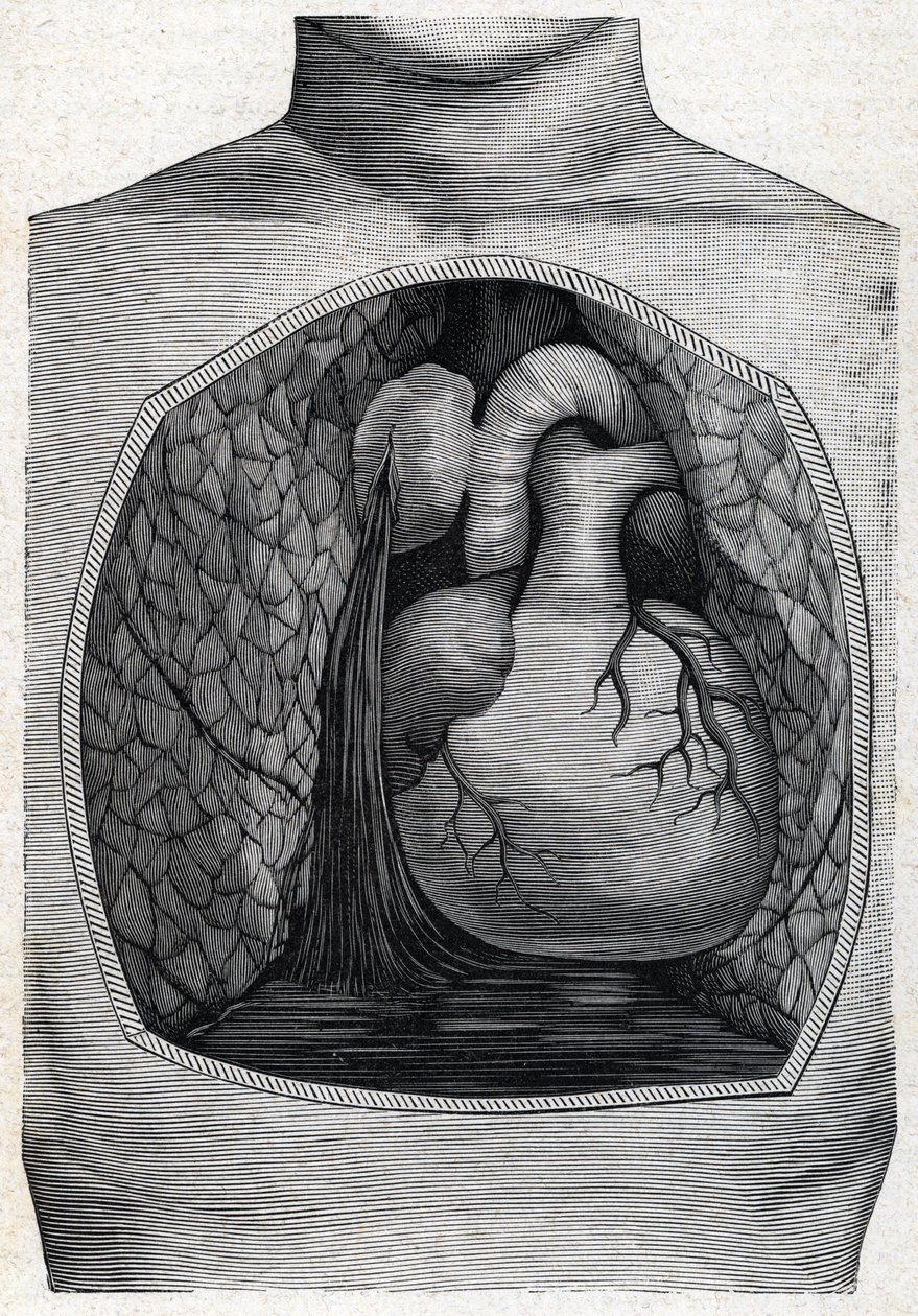 aneurysm ruptur (gravyr) 1888 av French School