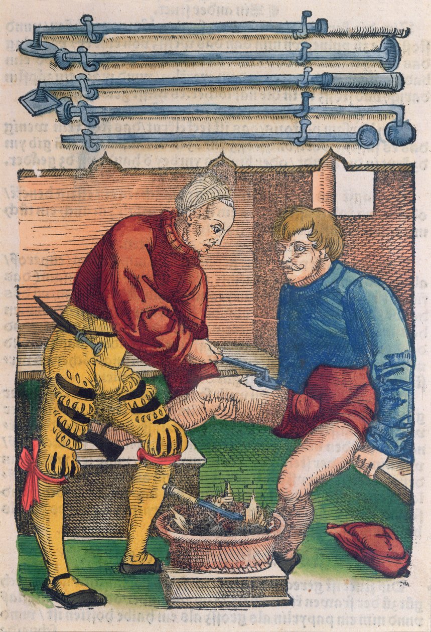 Cauterisation, illustration från 