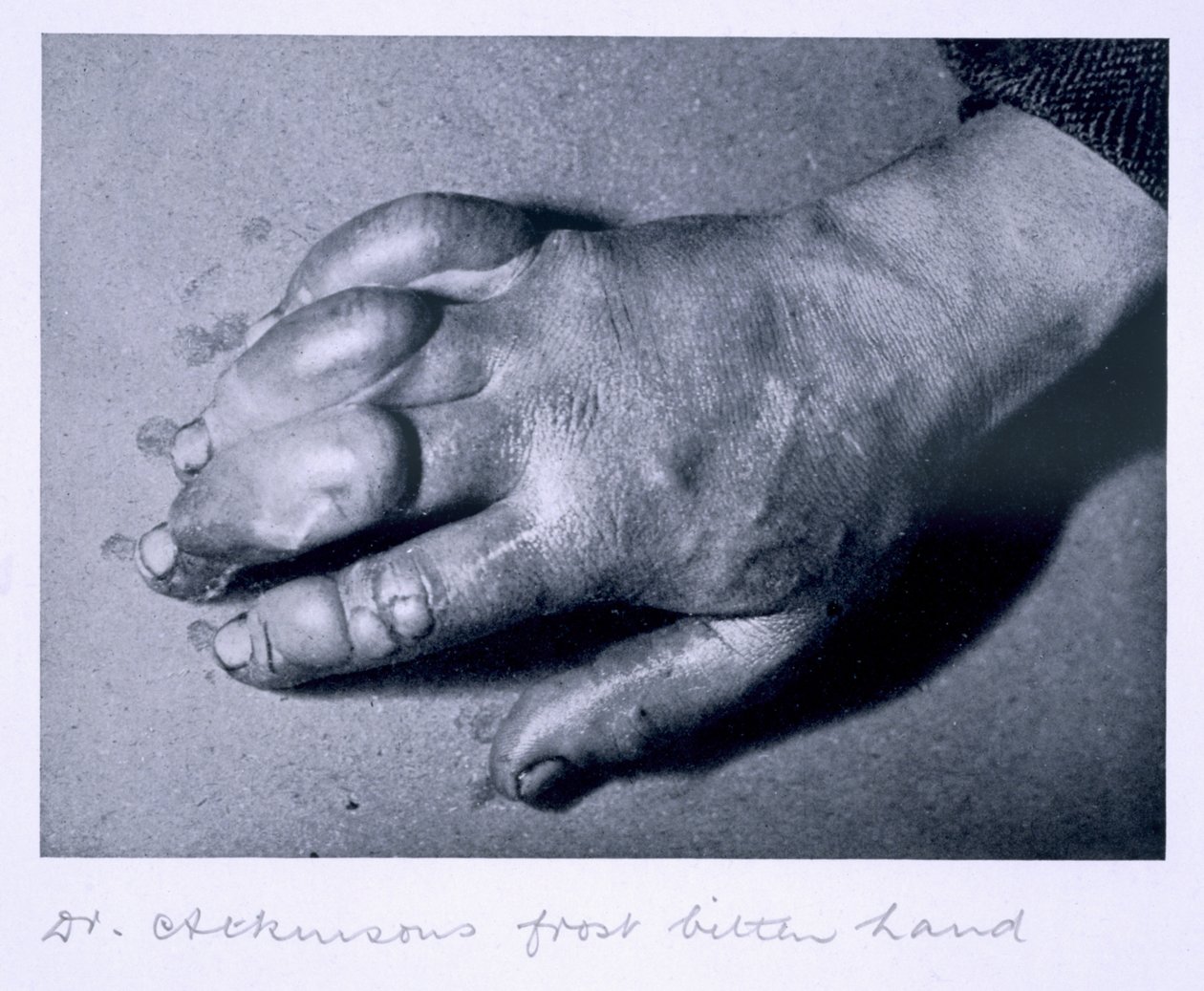 Dr. Atkinsons frostbitna hand, 1911 av Herbert Ponting