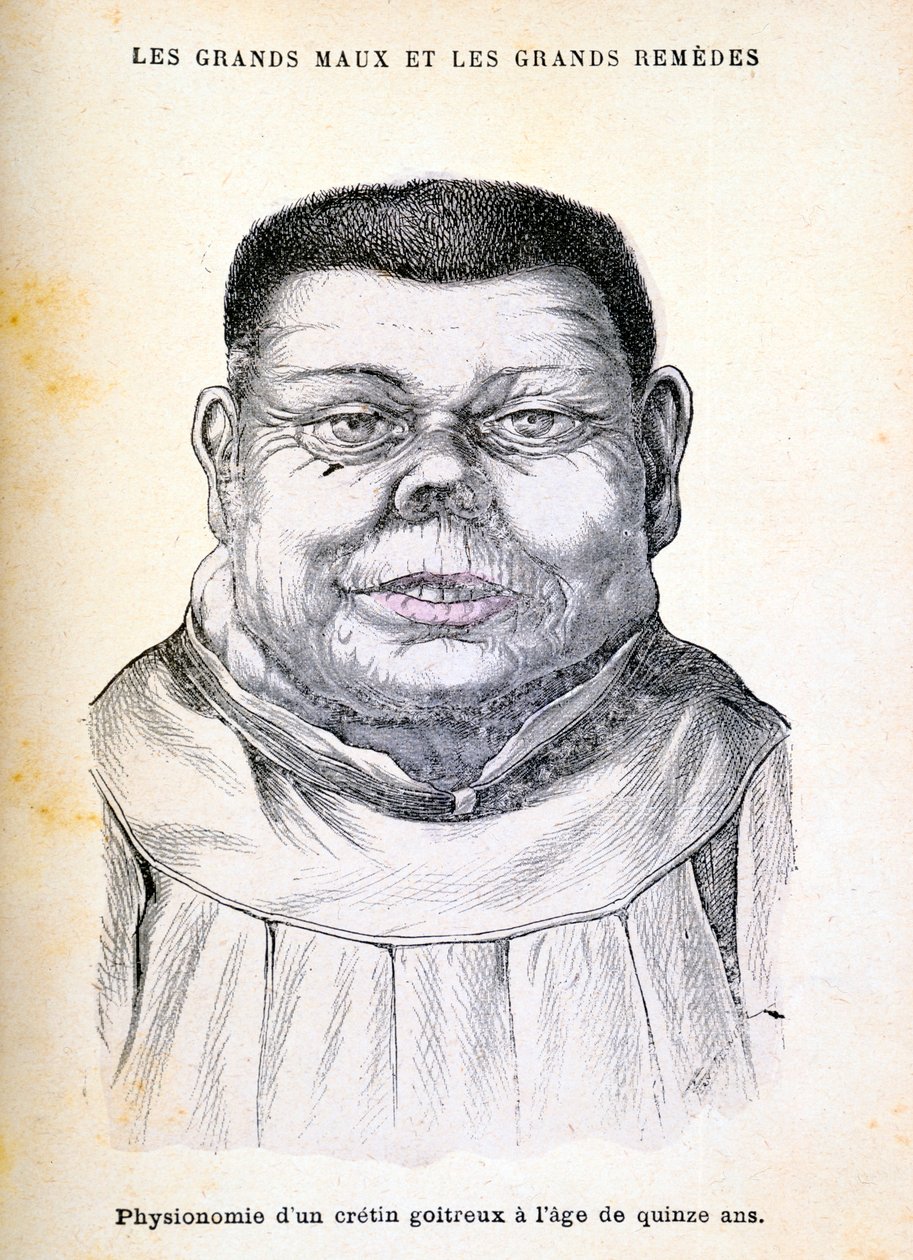 Cretin 15 år, c1890 av Unbekannt