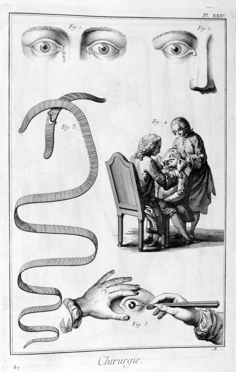 Ögonkirurgi, 1751-1777 av Unbekannt