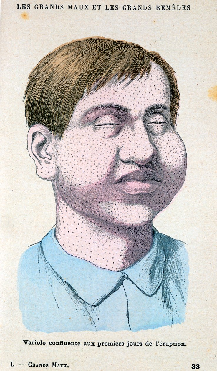 Smittkoppsoffer, c1890 av Unbekannt
