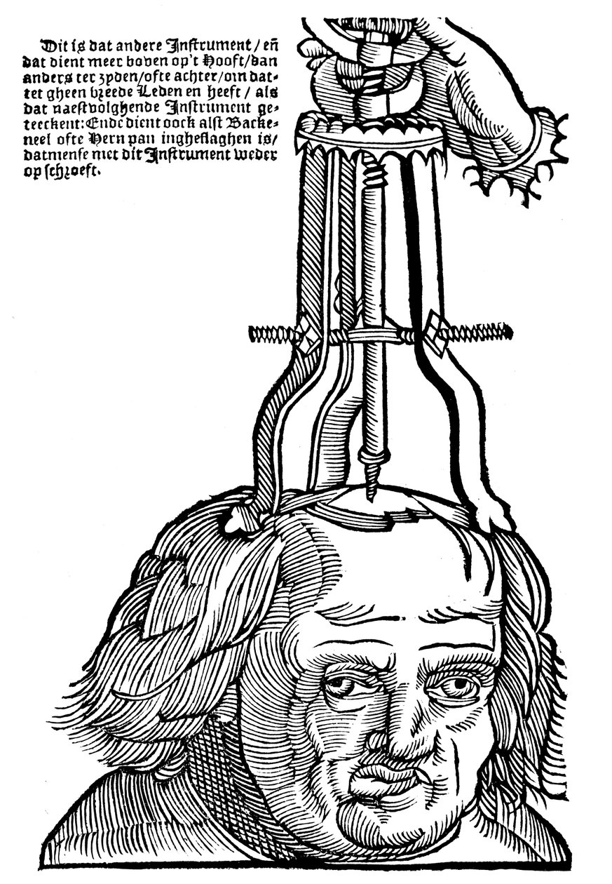 Trephination, 1593 av Unbekannt