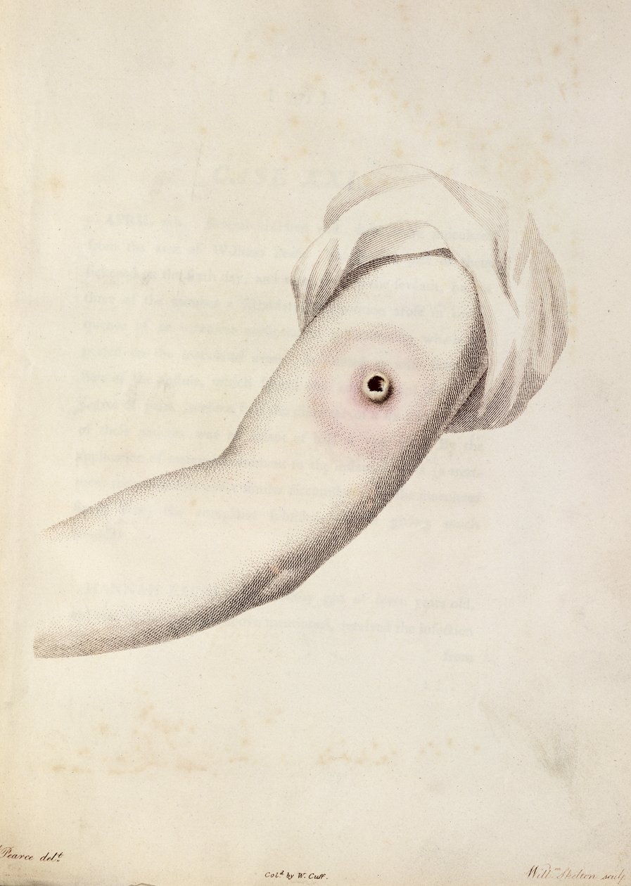 Kuvertkoppor på en arm, från "An Inquiry into the Causes and Effects of the Variolae Vaccinae" av Edward Jenner (1749-1823), graverad av Pearce, ca 1800. av William Skelton