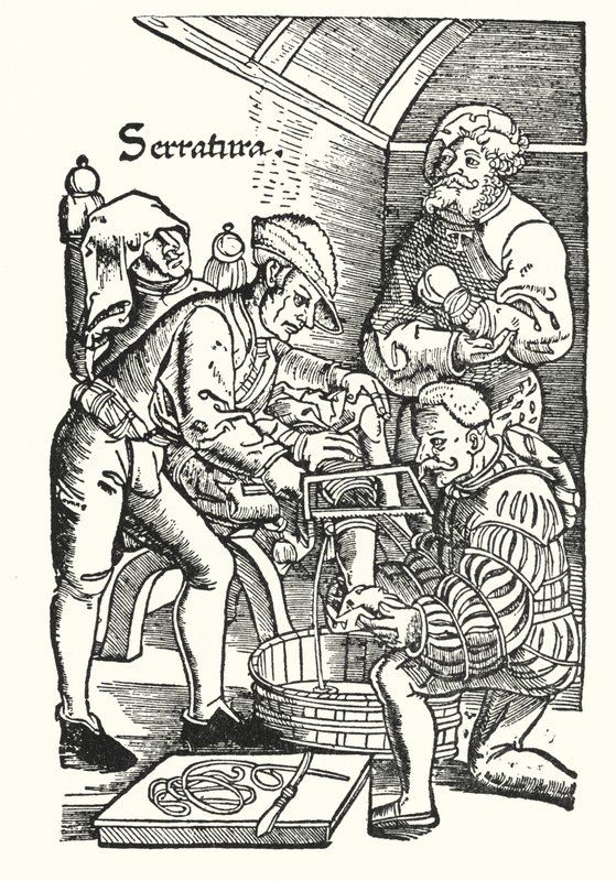 Amputation under sextonhundratalet (gravyr) av European School