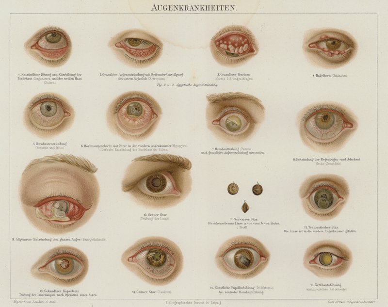 Ögonsjukdomar (färg litho) av German School