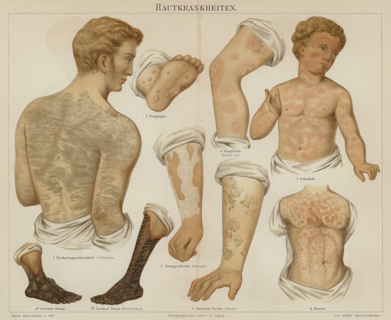 Hudsjukdomar (färg litho) av German School