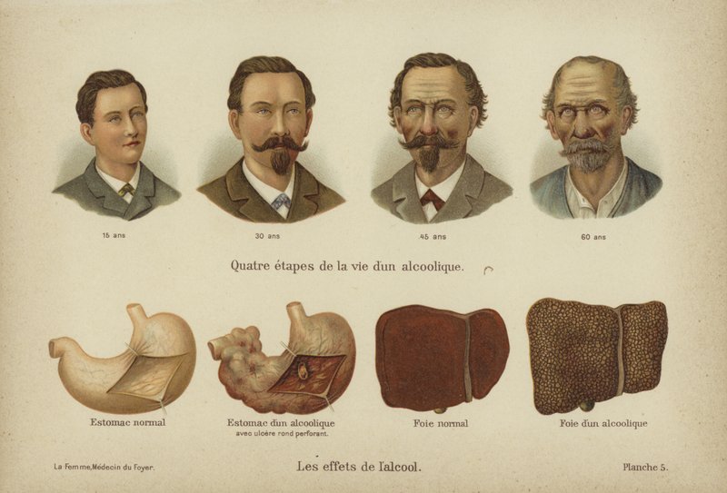 Effekterna av alkoholmissbruk (color litho) av German School